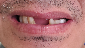 missing teeth before photo